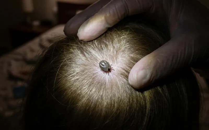 An engorged tick embedded at the part line of a child's scalp, found under a flashlight during a nightly check